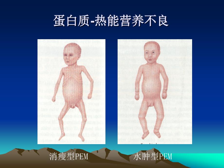 第四节_营养缺乏病的预防.ppt_第3页