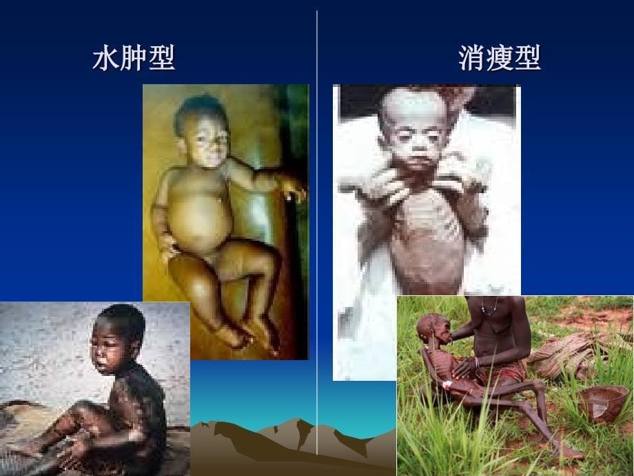 第四节_营养缺乏病的预防.ppt_第5页