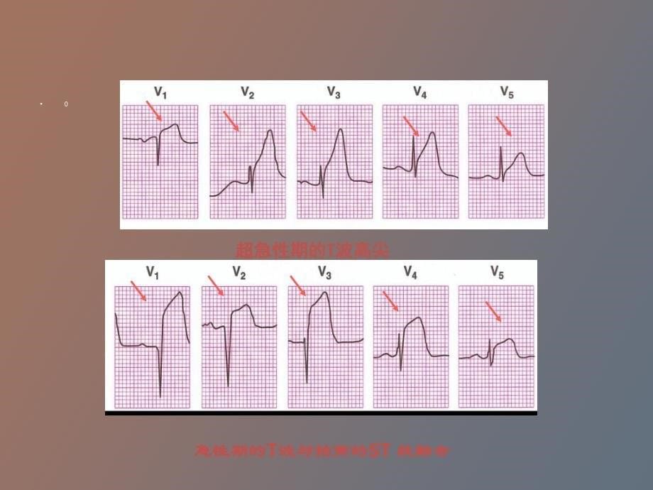 急性心肌梗死早期心电图分析_第5页