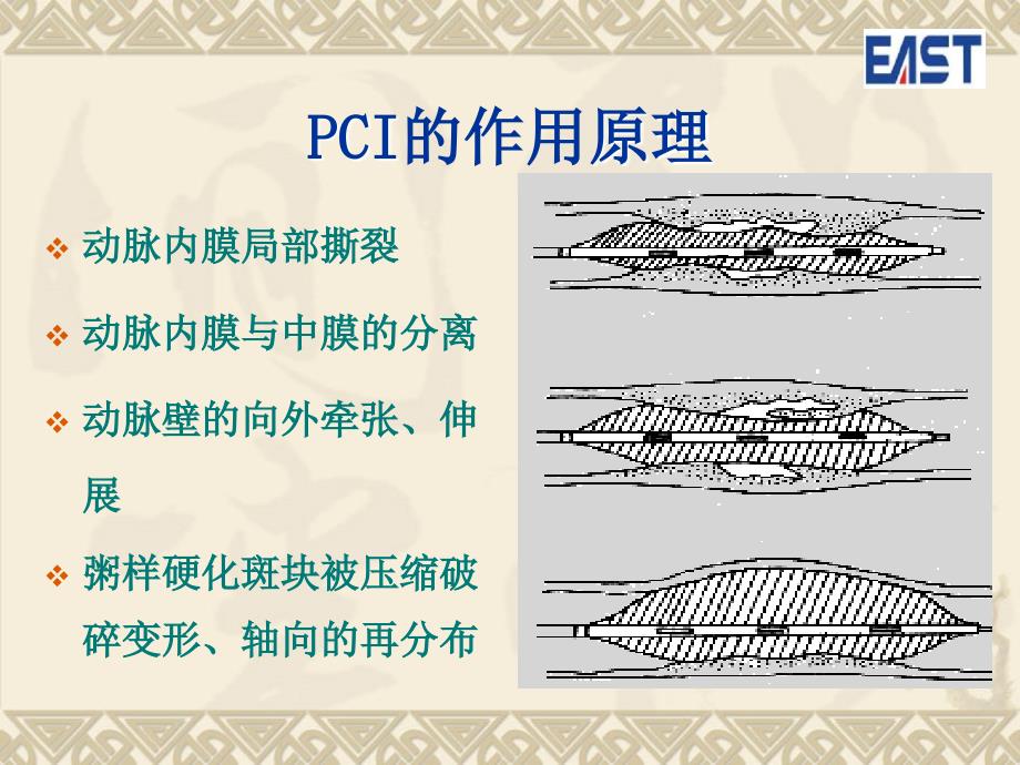 双导丝球囊介绍课件_第4页