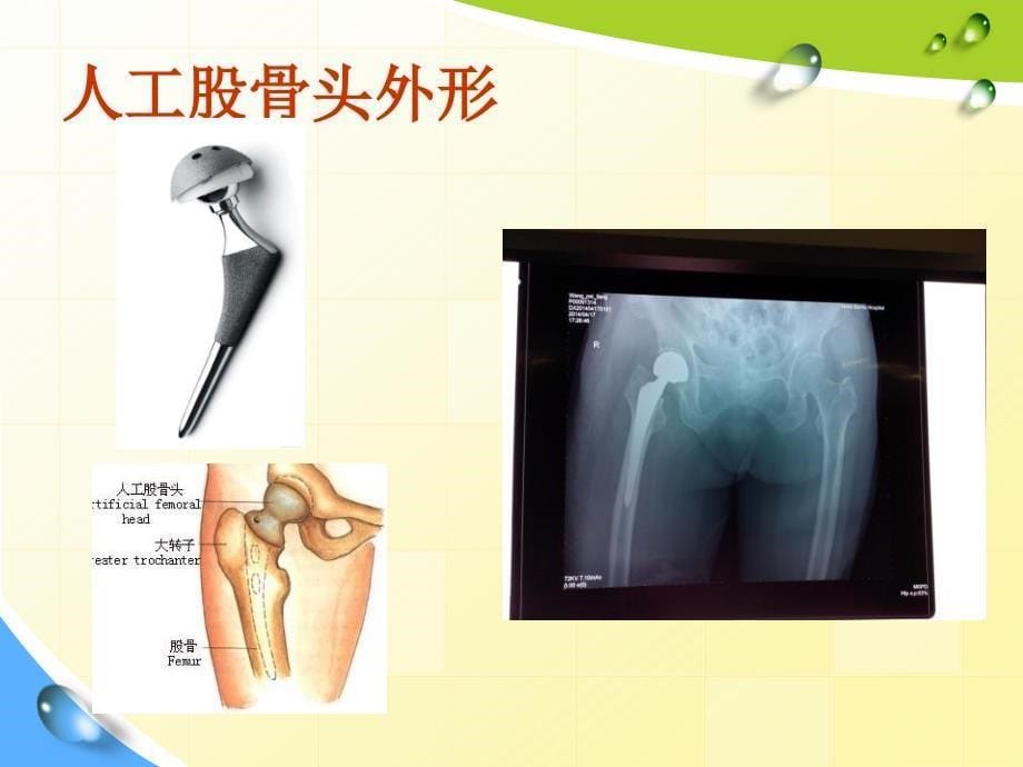 股骨头置换术后护理查房_第5页