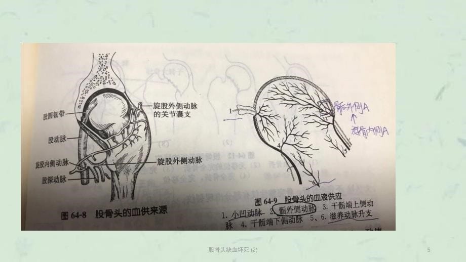 股骨头缺血坏死 (2)课件_第5页