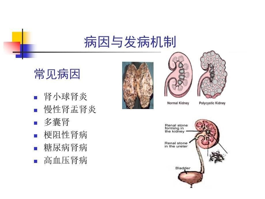 04慢性肾衰竭_第5页