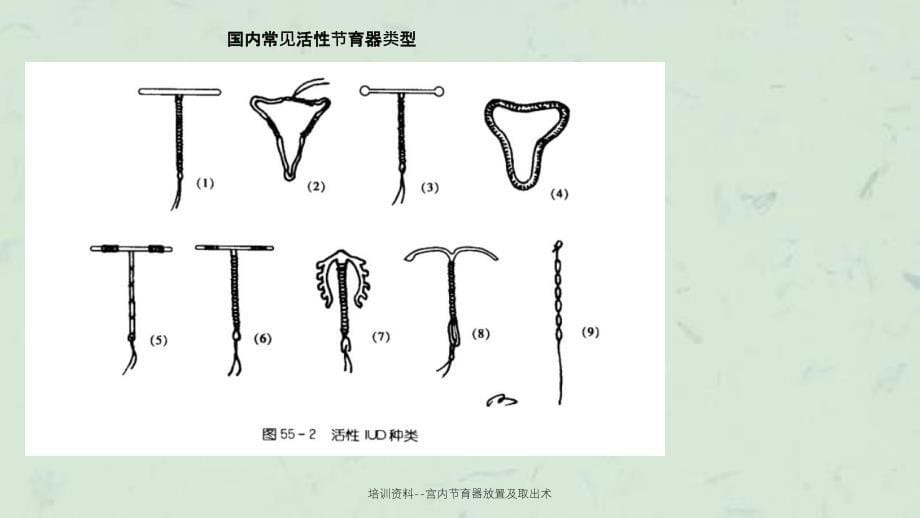 宫内节育器放置及取出术_第5页