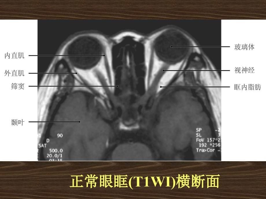 五官疾病MRI诊断.ppt_第5页