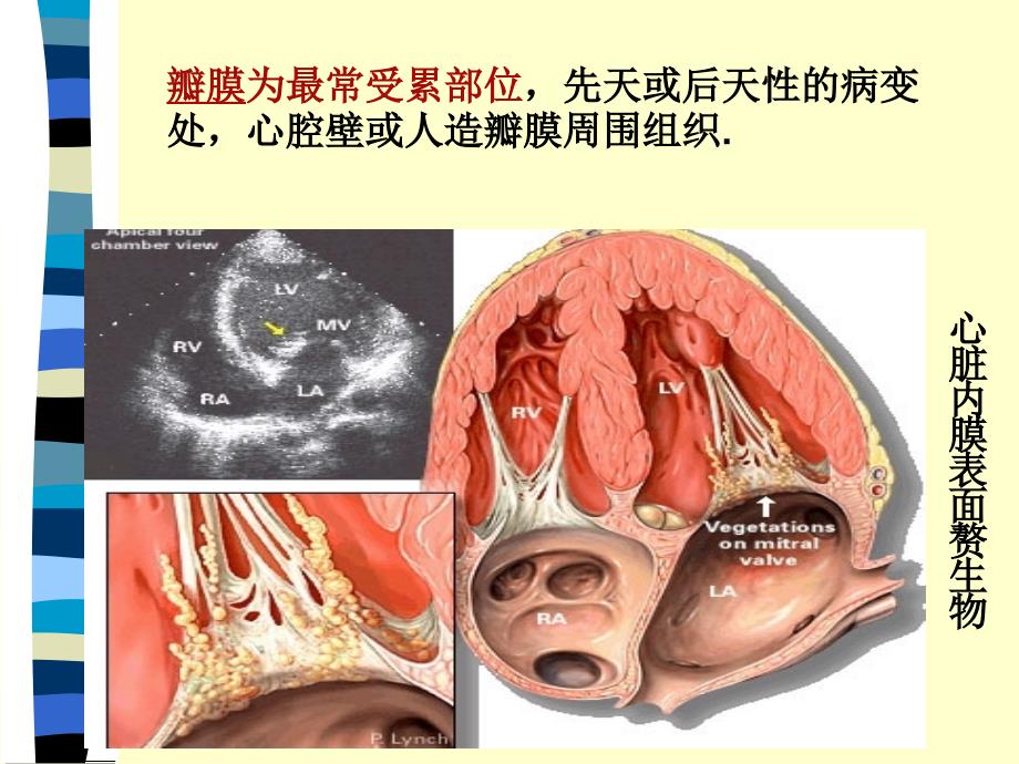 7第七节--感染性心内膜炎病人护理_第3页