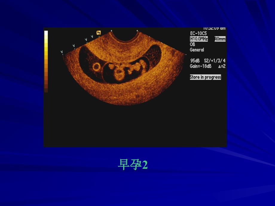 胎儿B超PPT课件_第4页