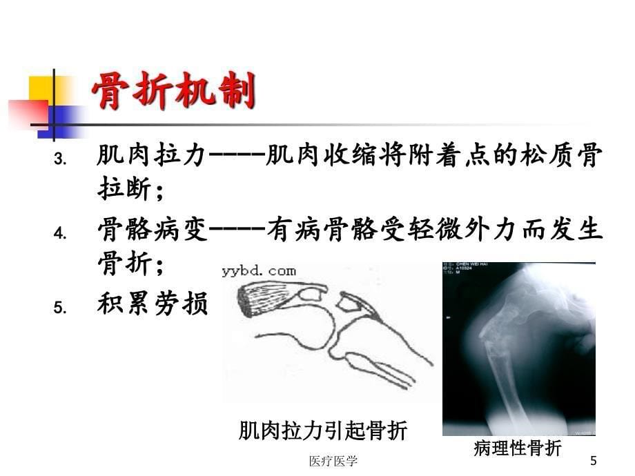 骨折患者护理业内特制_第5页