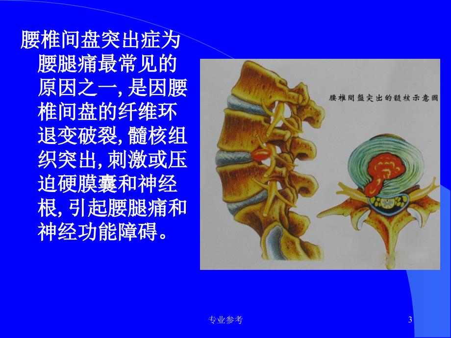 腰椎间盘突出症的中医治疗专业参考_第3页