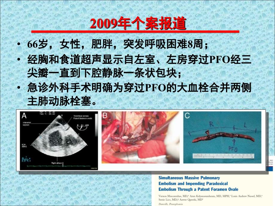 卵园孔未闭介入封堵指针今天还是明天_第4页