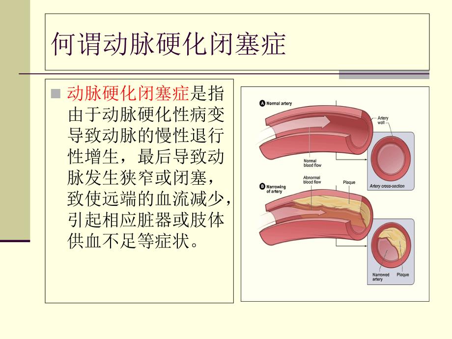 动脉硬化闭塞症中西医结合诊疗_第3页