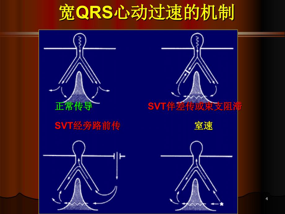 宽QRS心动过速的鉴别诊断_第4页