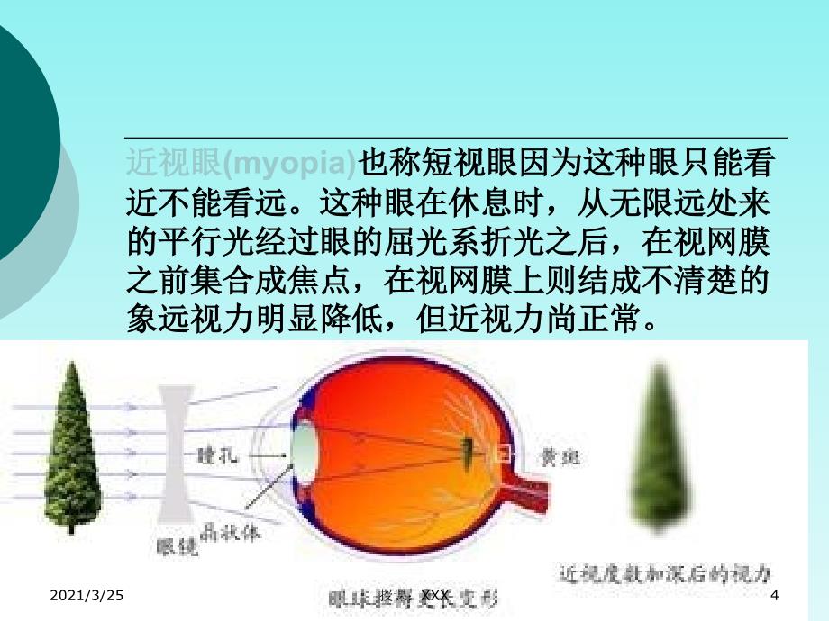 近视-健康教育PPT课件_第4页