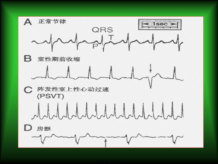 抗心律失常药-文档课件_第2页