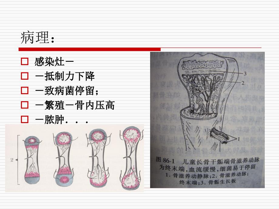 骨的感染PPT课件_第4页