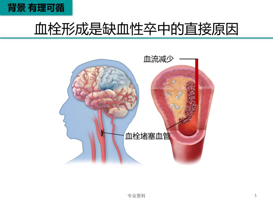 脑梗死再灌注治疗优质材料_第3页