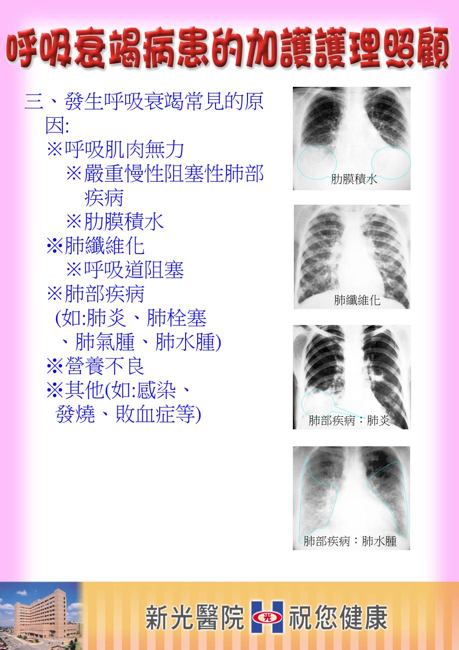 什麼是呼吸衰竭 是指呼吸道的氧氣交換無法_第2页