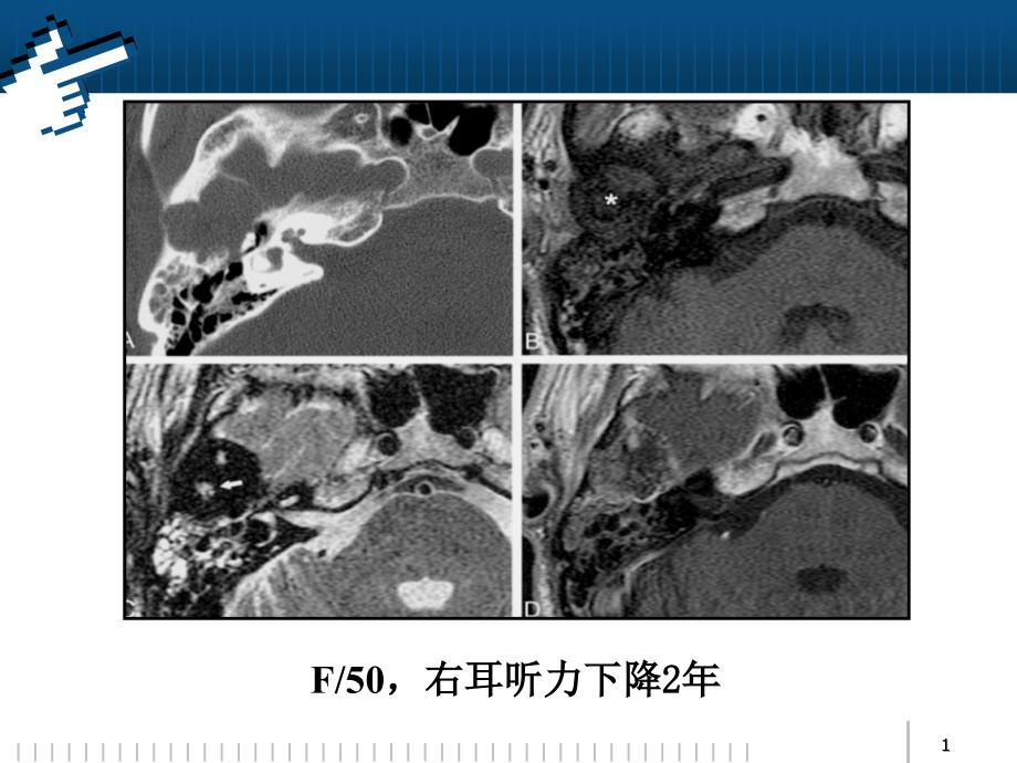 颞骨巨细胞修复性肉芽肿_第1页