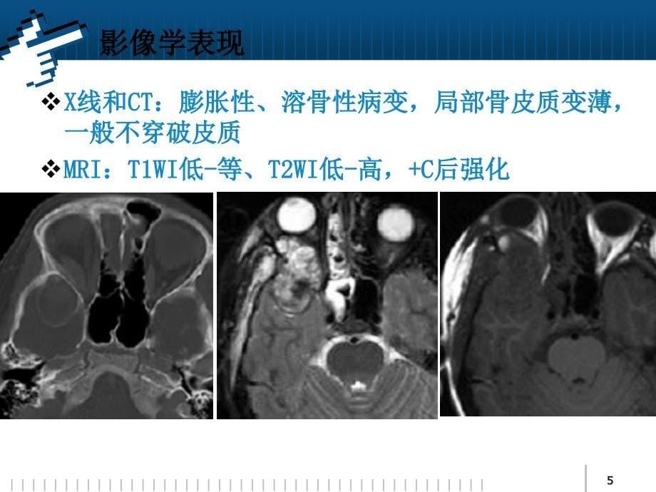 颞骨巨细胞修复性肉芽肿_第5页