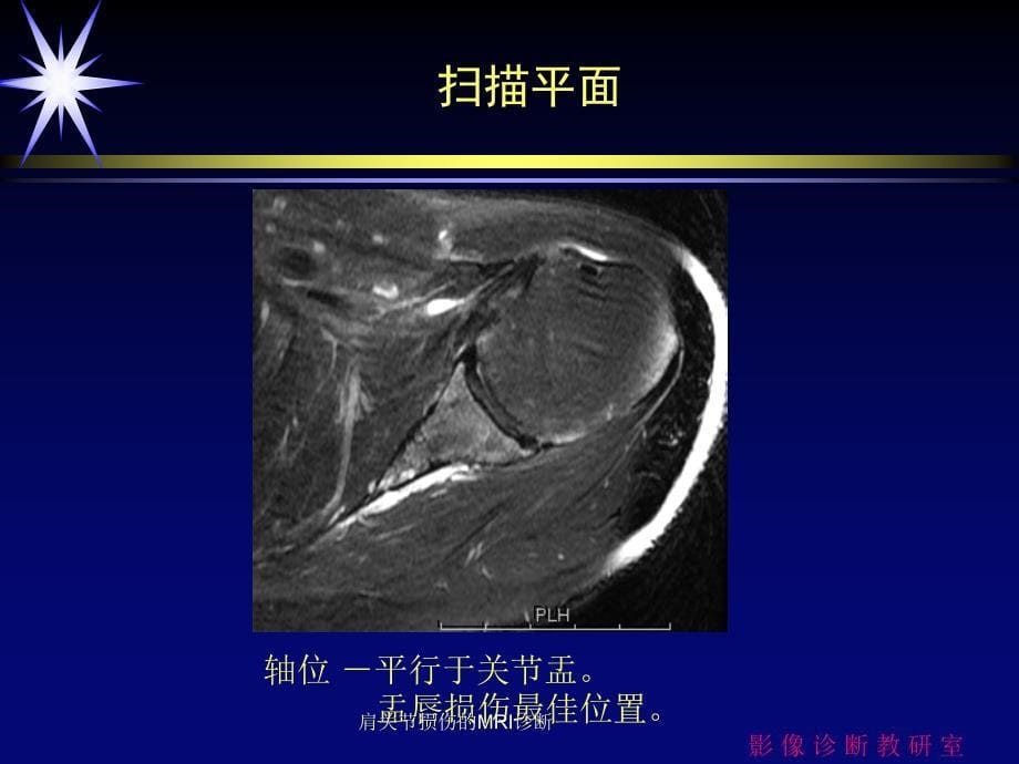 肩关节损伤的MRI诊断课件_第5页