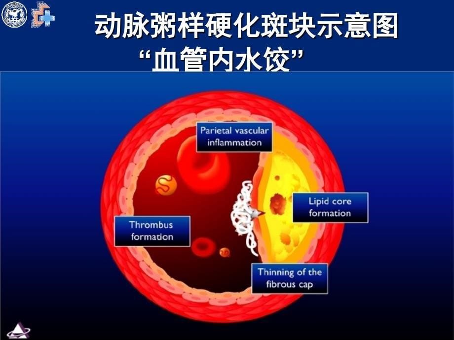 降胆固醇治疗从指南到实践PPT课件_第5页