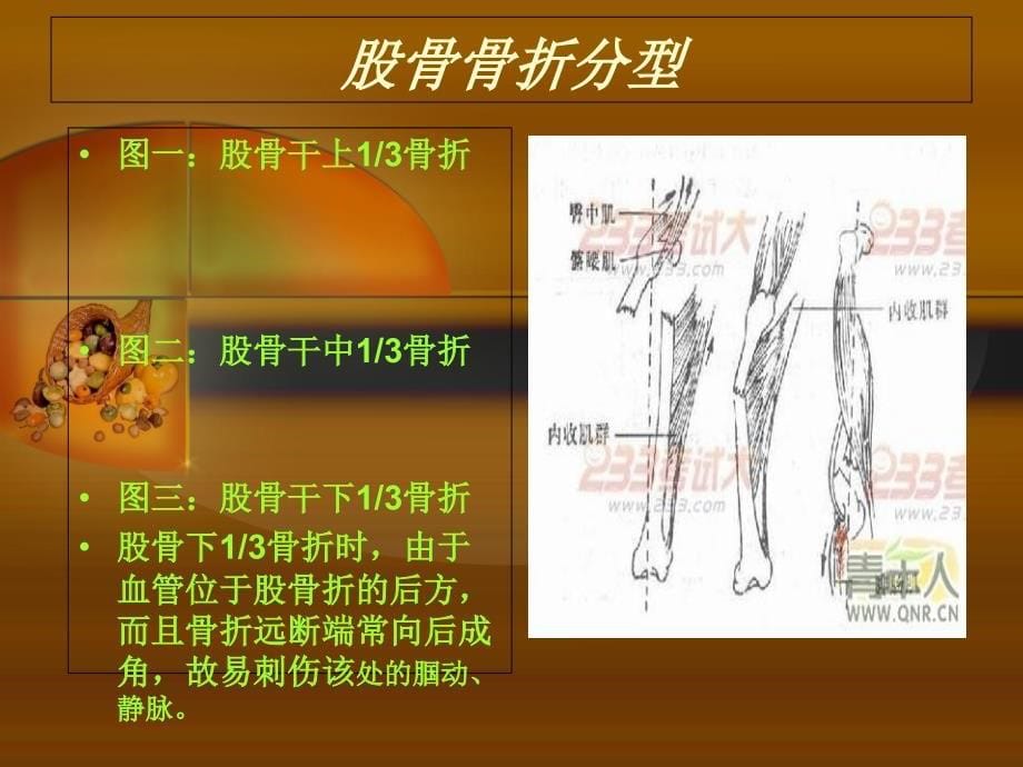 股骨干骨折护理查房_第5页