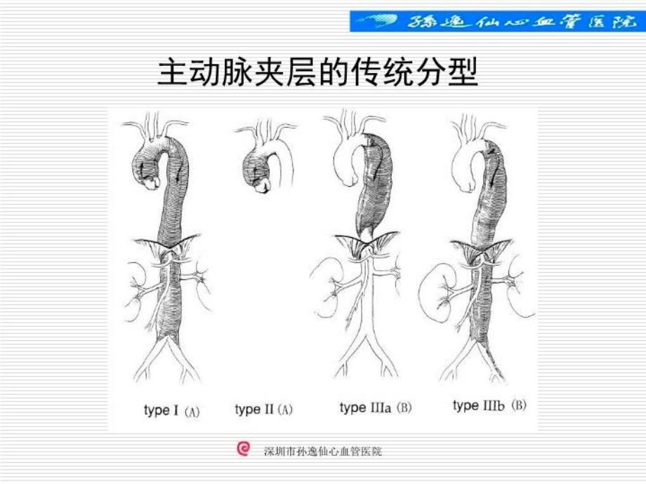 孙氏手术在A型主动脉夹层外科治疗中的应用课件_第4页