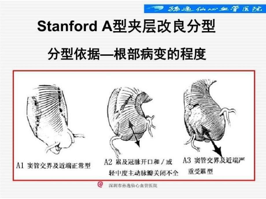 孙氏手术在A型主动脉夹层外科治疗中的应用课件_第5页