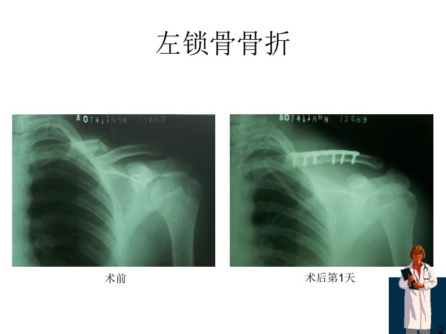 骨折X线片汇总_第2页