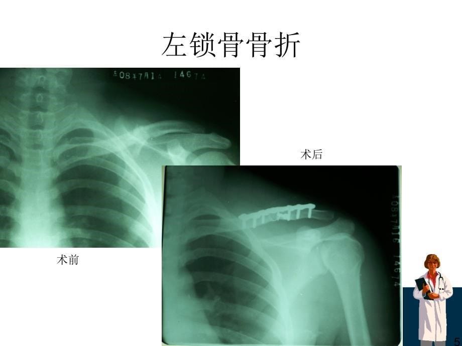 骨折X线片汇总_第5页