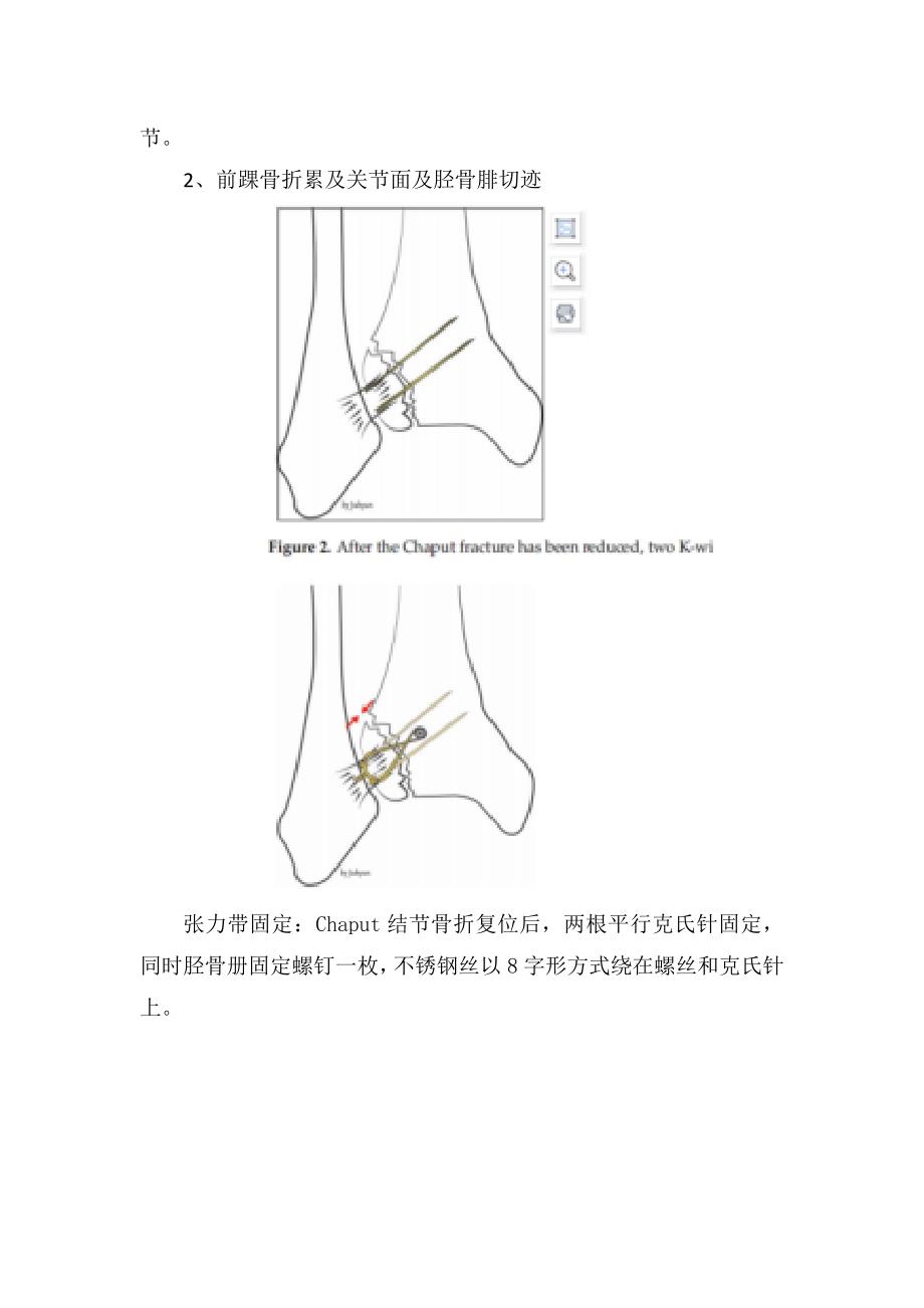 临床前踝骨折损伤机制、骨折分类、前踝手术治疗目的及手术指征_第5页