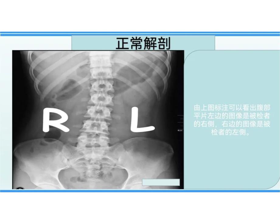 腹部X线摄影检查解剖、体位和技术要求及注意事项_第3页