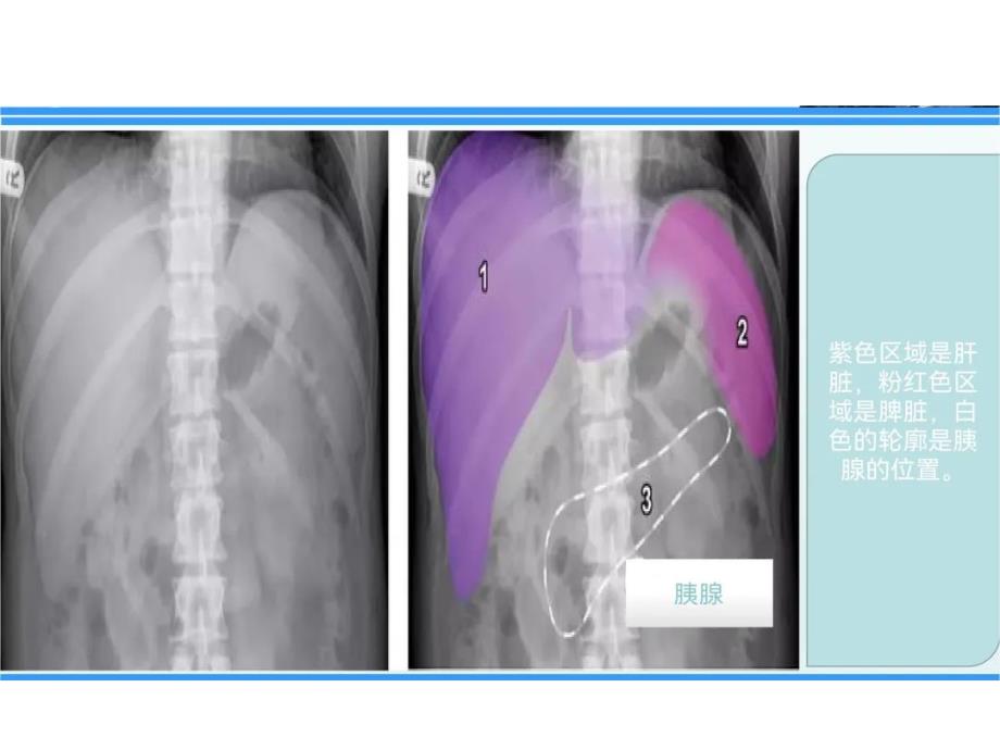 腹部X线摄影检查解剖、体位和技术要求及注意事项_第5页