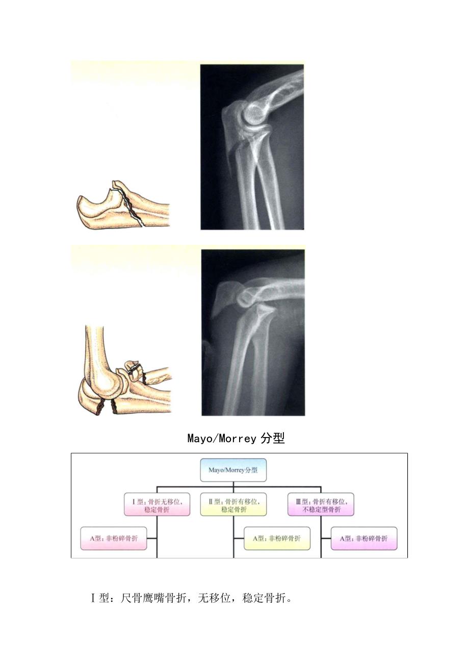 临床骨科Schweitzer分型、 Mayo和Morrey分型、Colton分型等尺骨鹰嘴骨折分型疾病分类及影像学特征_第3页