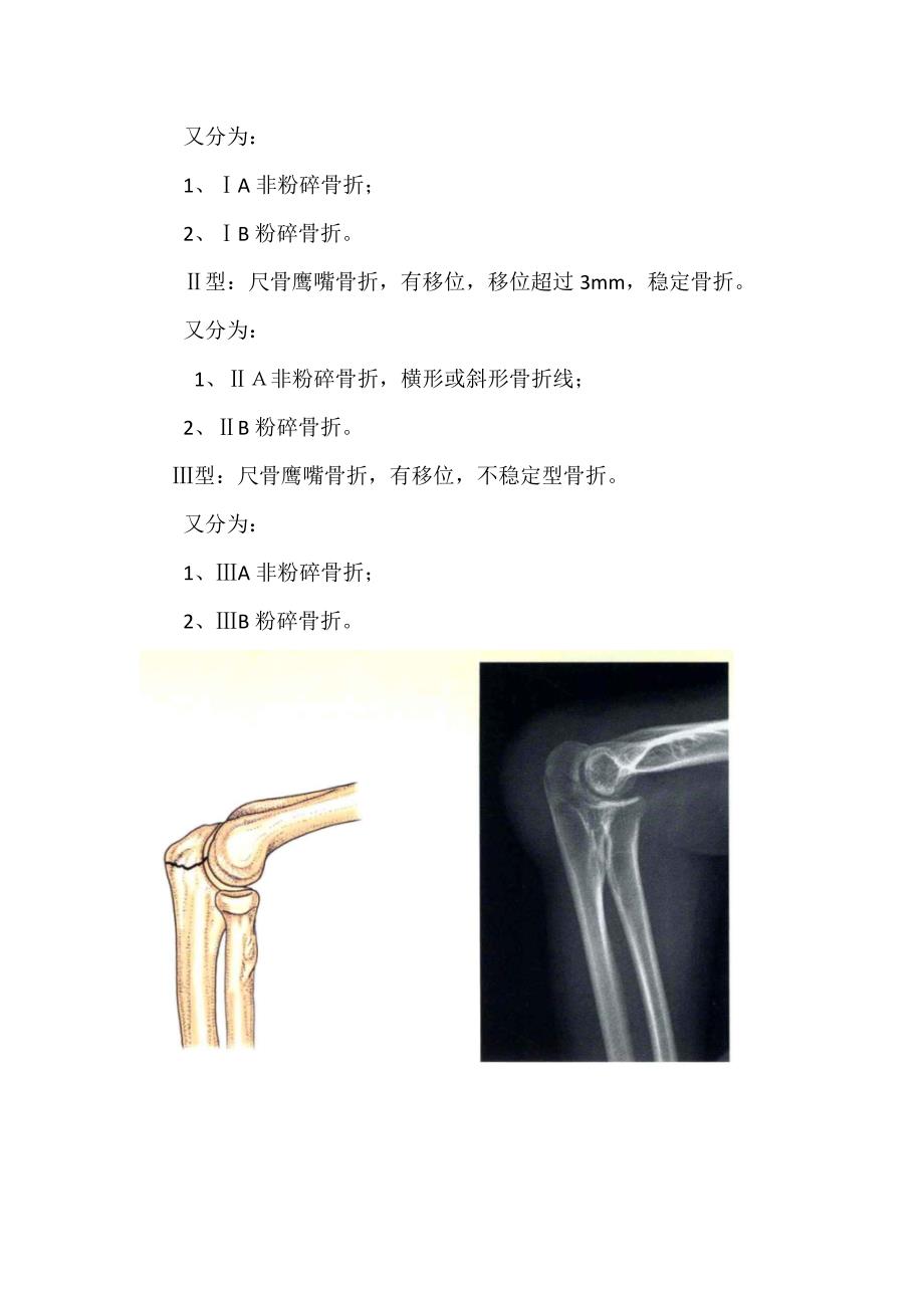 临床骨科Schweitzer分型、 Mayo和Morrey分型、Colton分型等尺骨鹰嘴骨折分型疾病分类及影像学特征_第4页