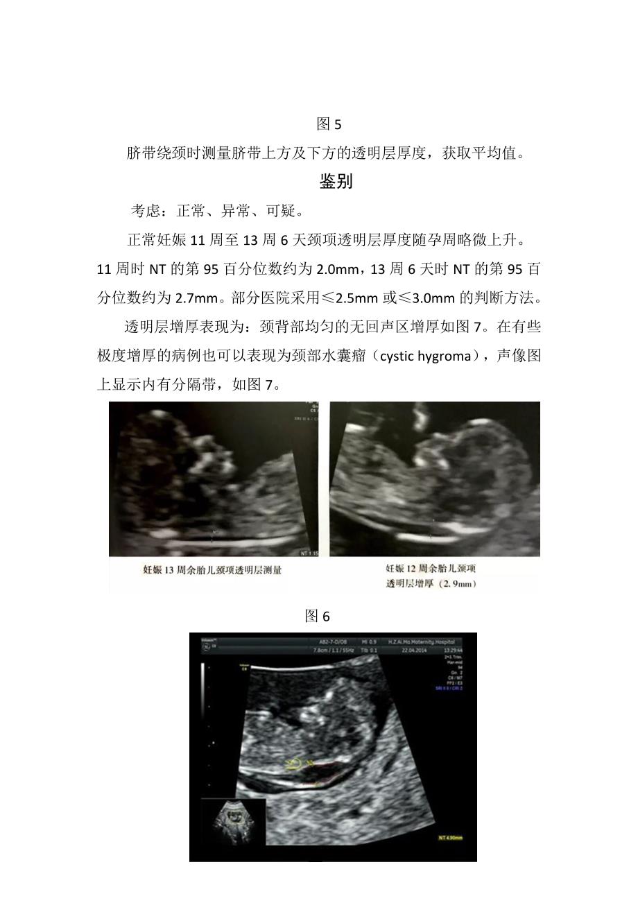临床妊娠期NT测量选择和观察、鉴别及诊断和进展_第4页