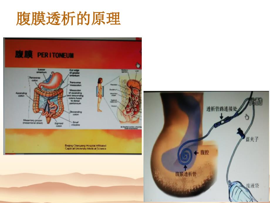 腹膜透析的讲解 ppt课件_第3页