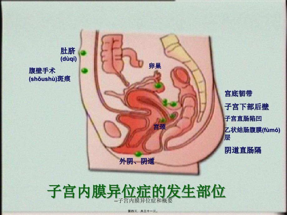 --子宫内膜异位症和概要课件_第4页