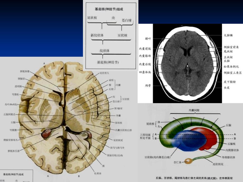 双侧丘脑对称性病变影像学_第4页