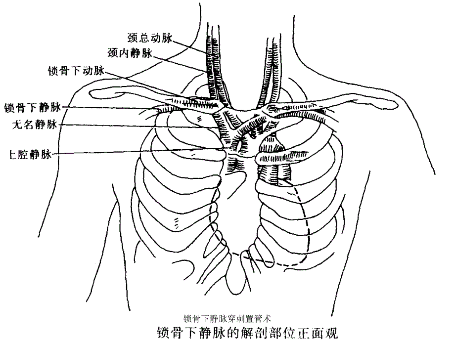 锁骨下静脉穿刺置管术_第3页