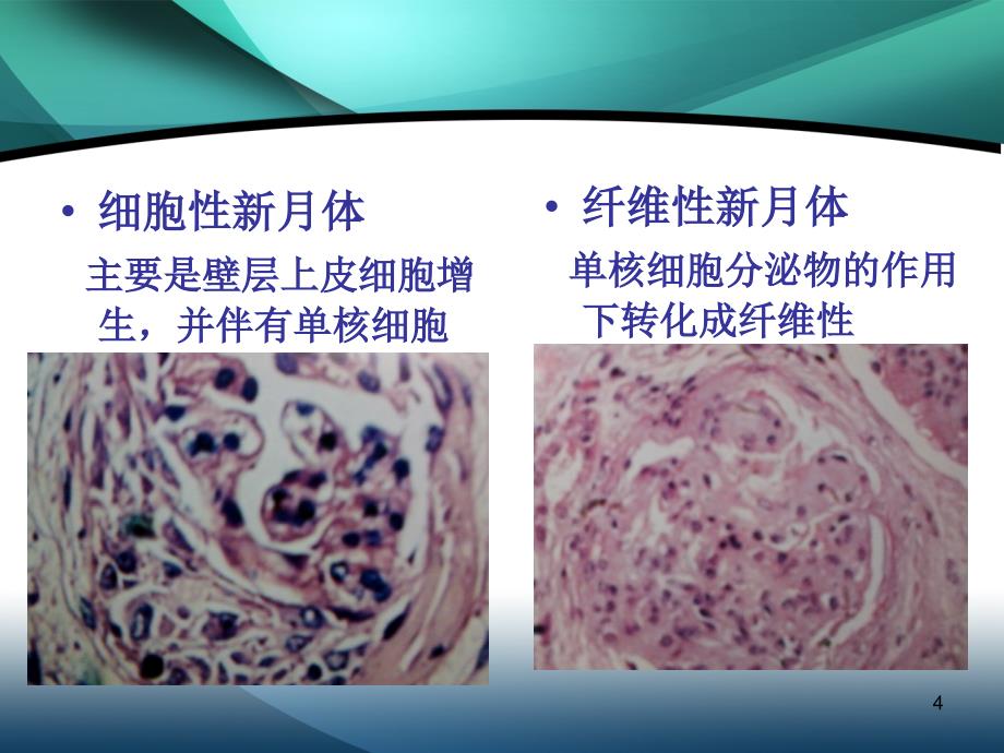 肾活检光镜结果分析ppt课件_第4页