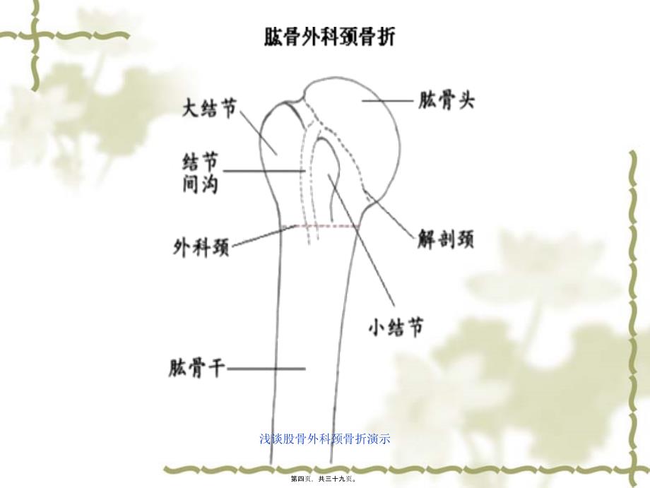 浅谈股骨外科颈骨折演示课件_第4页