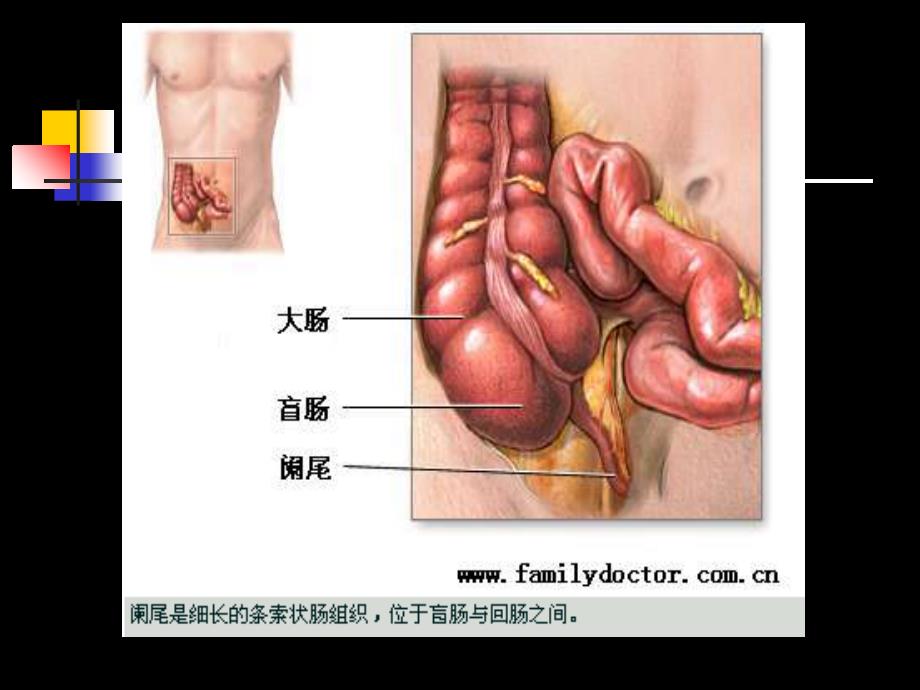 阑尾炎病人护理_第4页