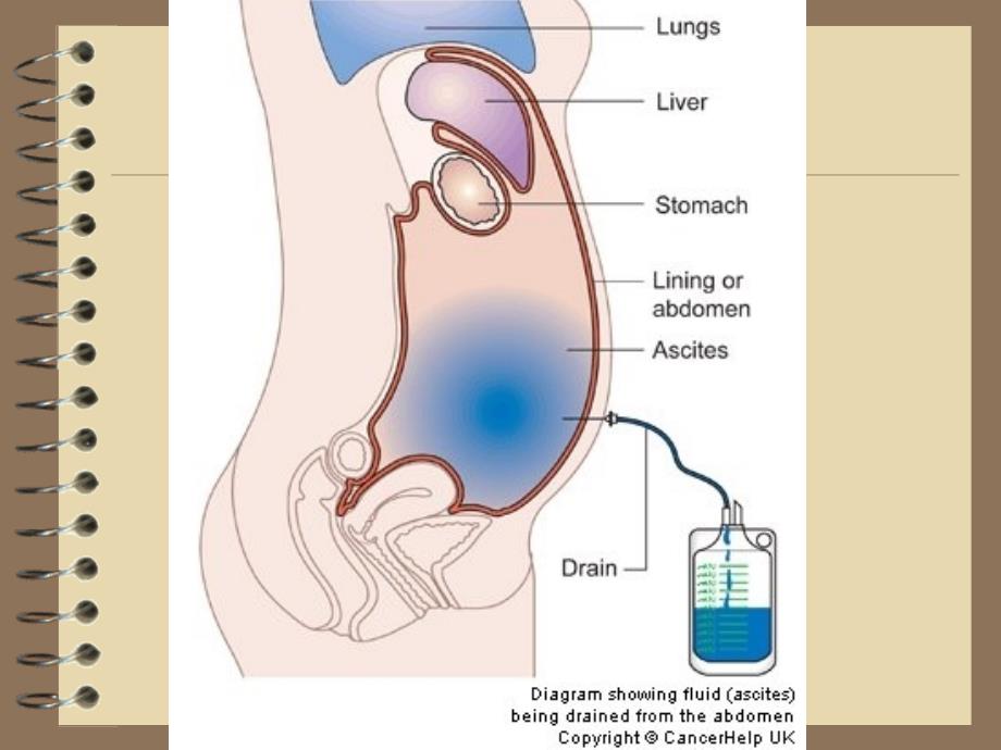 腹腔穿刺术及护理_第3页