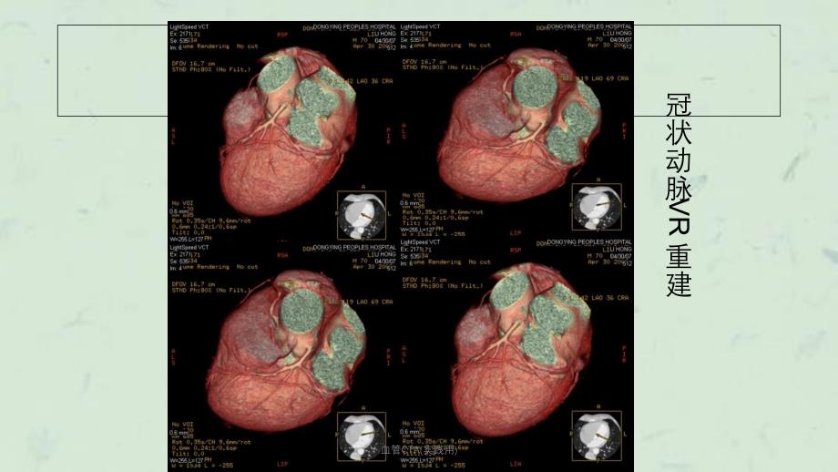血管CTA实践用课件_第3页