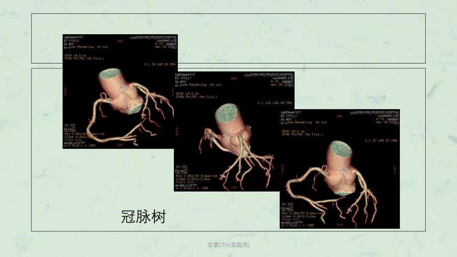 血管CTA实践用课件_第4页