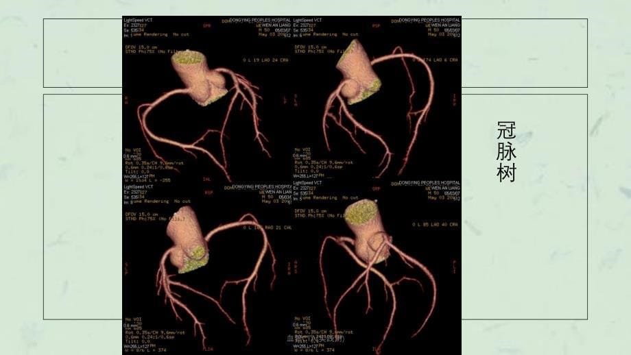 血管CTA实践用课件_第5页