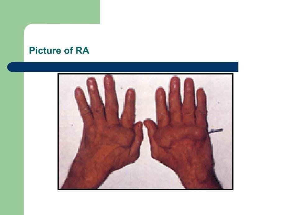 初诊患类风湿性关节炎1年余_第5页