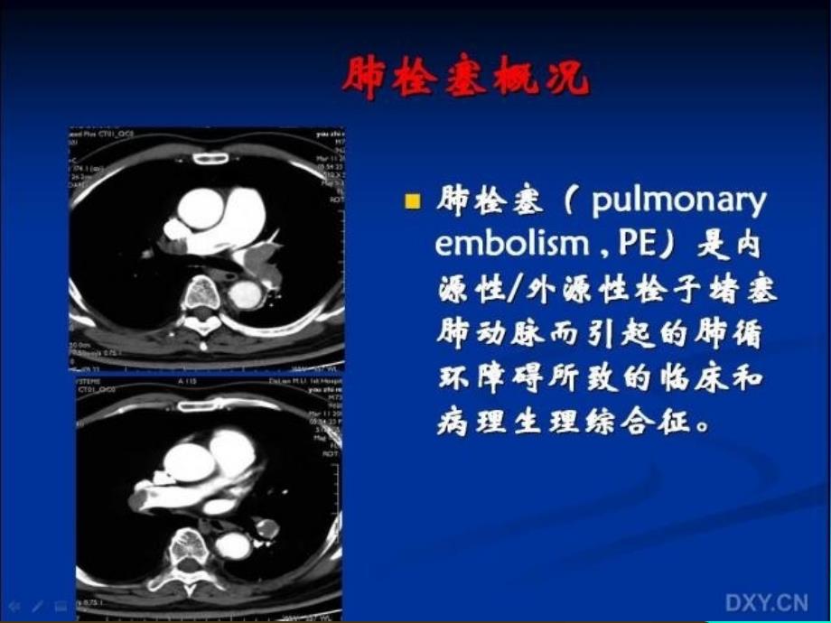 肺栓塞与肺梗死的影像学诊断_第2页