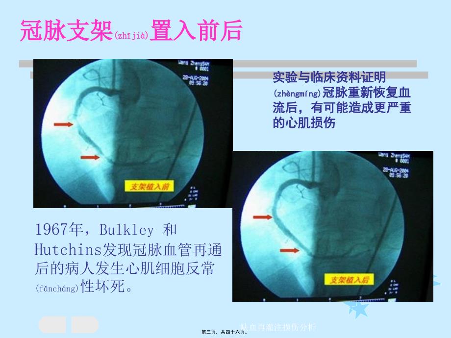 缺血再灌注损伤分析课件_第3页